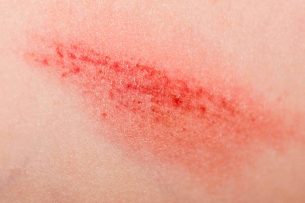 حلمت اني اتعورت في وشي في المنام