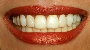 تفسير حلم اللحم عالق بين الاسنان في المنام